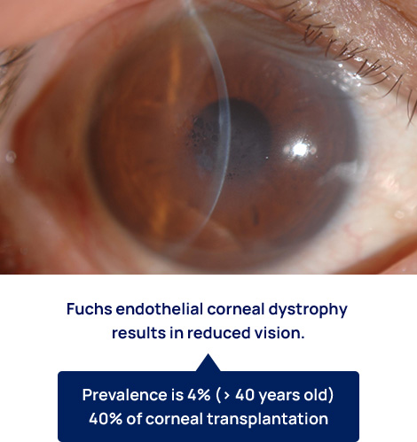 corneal degeneration treatment